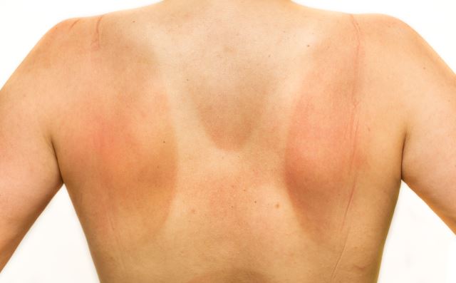 Woman's naked back having sunburn in white background