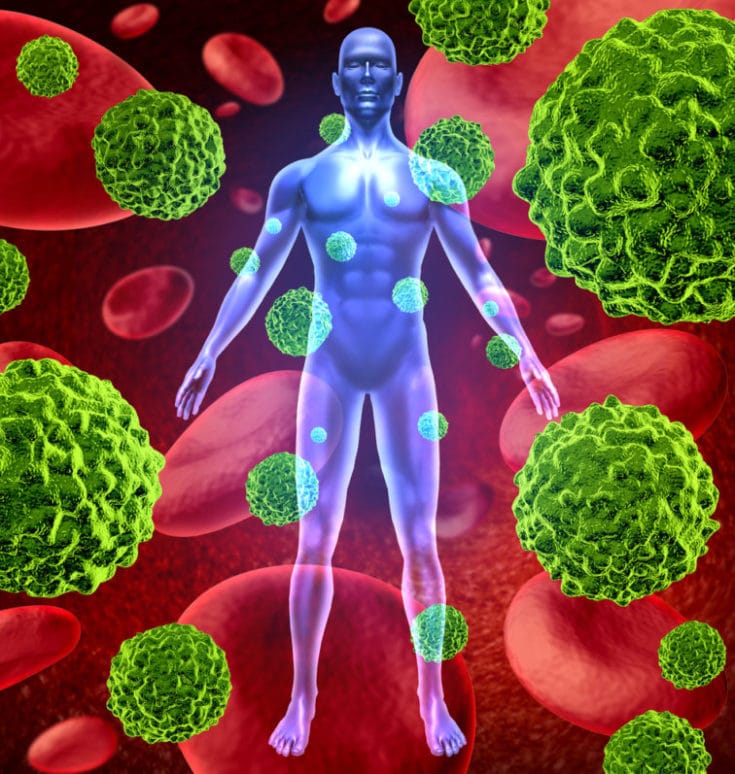 Human body with cancer cells spreading and growing through the body via red blood as malignant cells due to environmental carcinogens and genetic tumors and cel